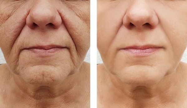 Learn more about Morpheus8 Treatment West Dulwich today!