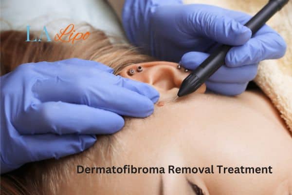 Dermatofibroma Removal Treatment West Dulwich