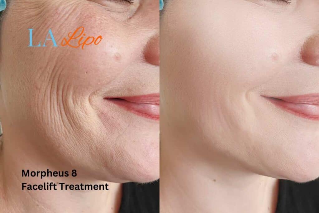 Morpheus8 Treatment West Dulwich for flawless skin! Call us today!