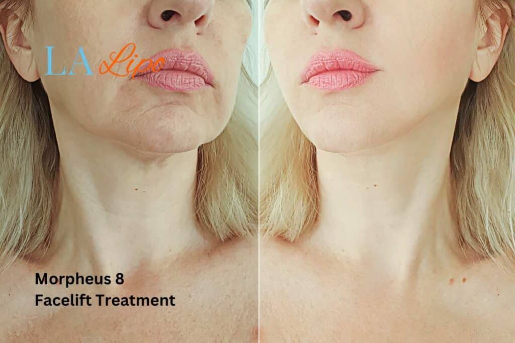 Turn back time with Morpheus8 Treatment West Dulwich