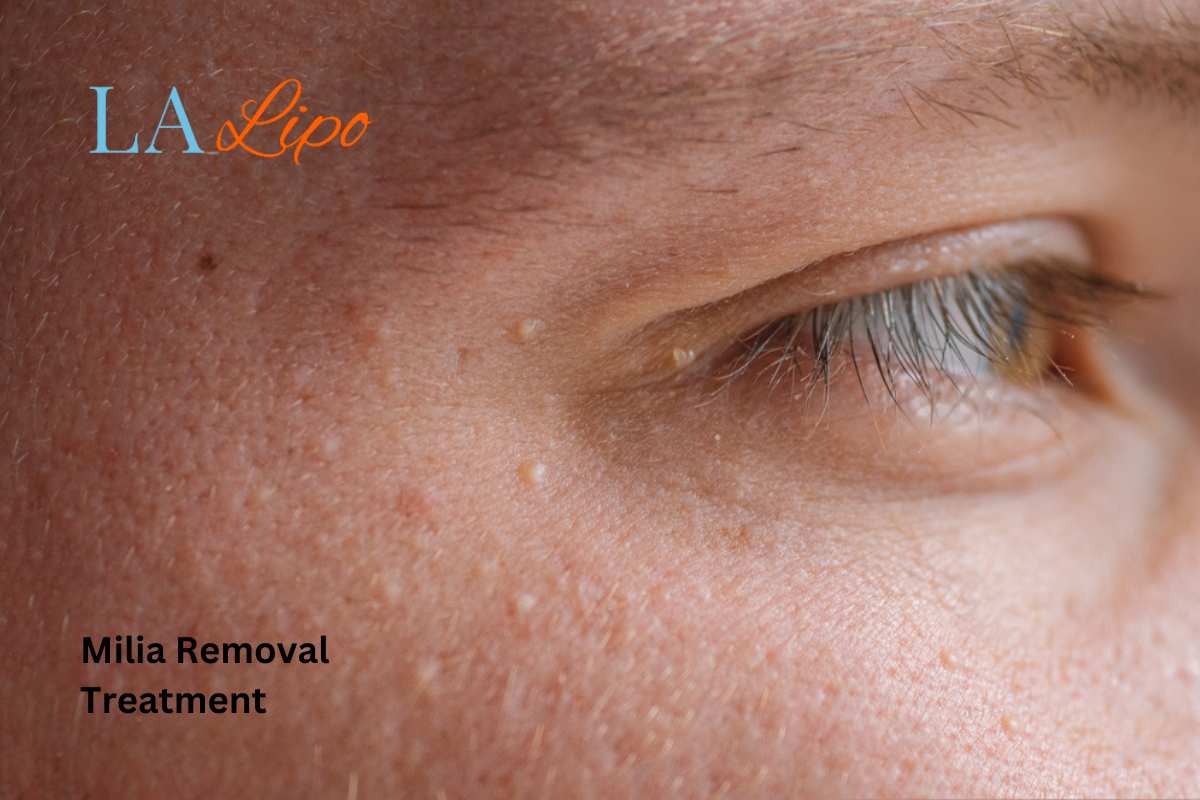 Cryopen Milia Removal: Is It the Easiest and Safest Option West Dulwich?