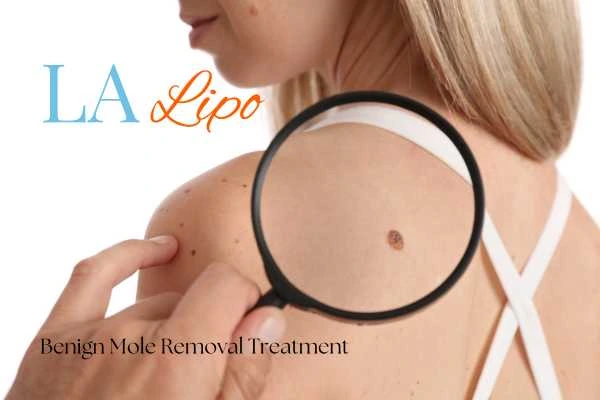 Why getting moles removed West Dulwich can boost your confidence!