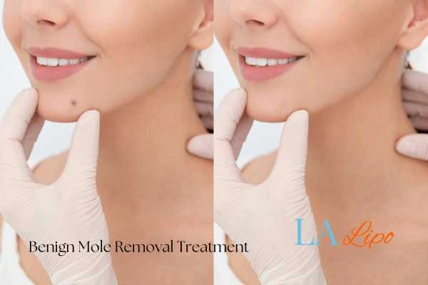 Woman's before and after results of being moles removal treatment West Dulwich