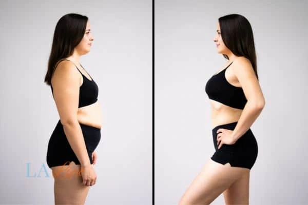 image of woman before and after results of LA-EMS Body Sculpting West Dulwich to help treat Diastasis recti