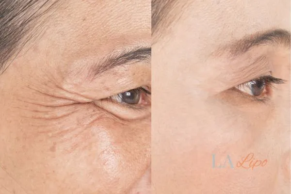 Before and after results of woman - HI-fu wrinkles reduction treatment West Dulwich