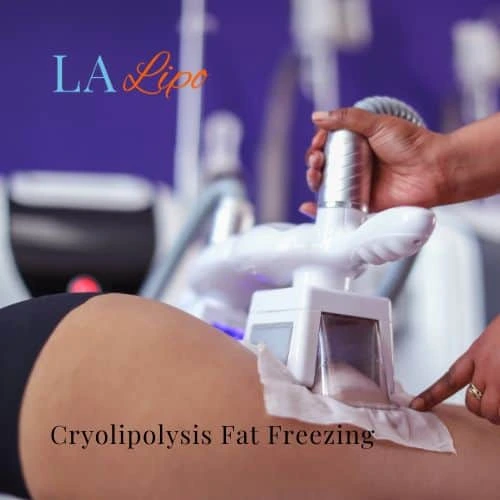 fat freezing - Cryolipolysis West Dulwich