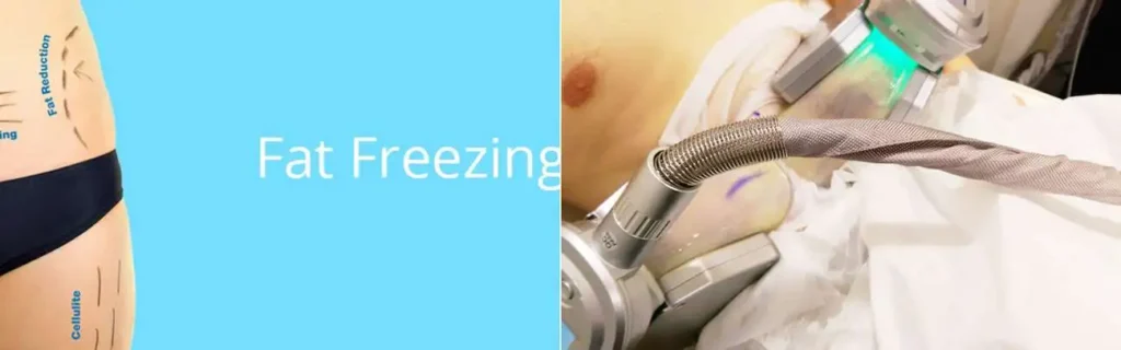 Fat freezing West Dulwich on multiple areas of the body