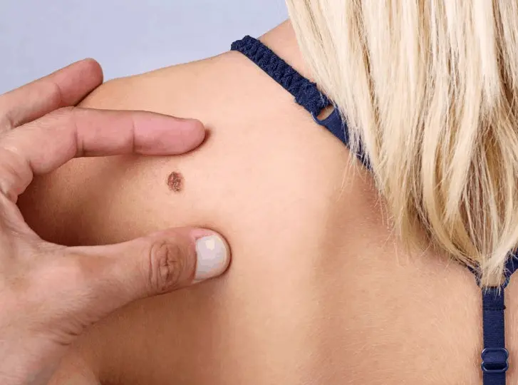 woman having mole removal West Dulwich consultation before treatment.