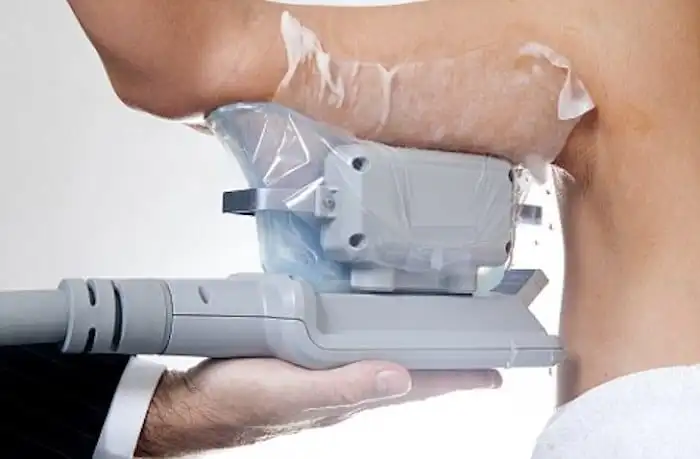 Picture of fat freezing West Dulwich on the upper arms.