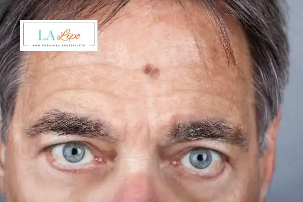 Solar Lentigo Removal West Dulwich image of man with mark on his forehead