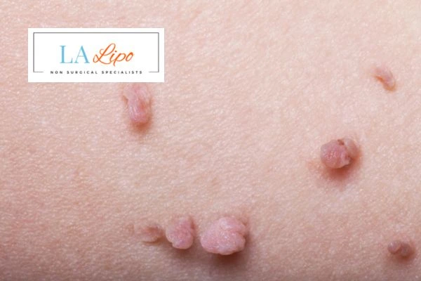 Does cryopen skin tag removal West Dulwich hurt? Find out now call our team today!