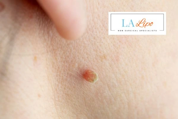 Book skin tag removal West Dulwich today speak to our team now!