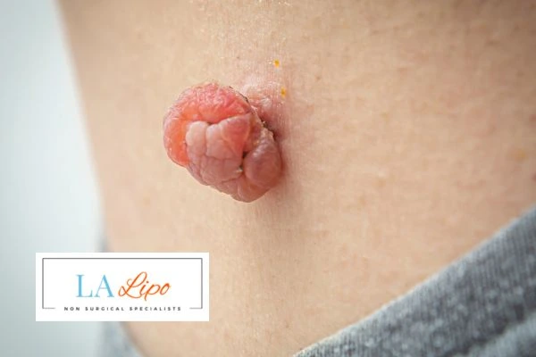 Interested in skin tag removal West Dulwich? Concerned about the pain? Find out more today!