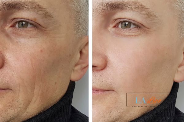See the amazing results of Morpheus8 Treatment West Dulwich!