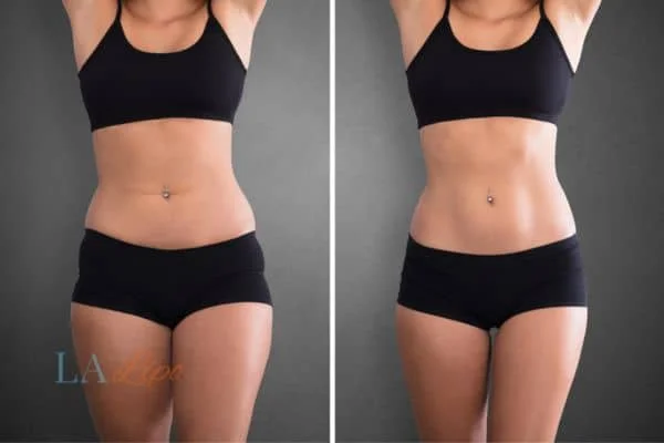 before and after results of non-surgical treatment to help a woman's body image and mental health West Dulwich