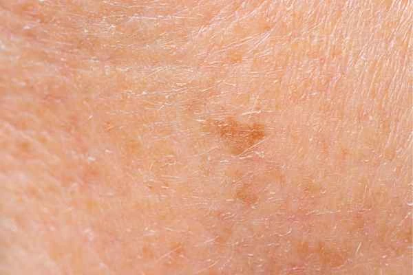 close up picture of age spots West Dulwich