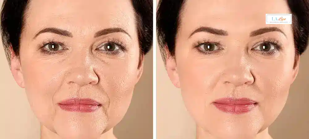 How Long Does It Take to See Results and How Long Do They Last West Dulwich?